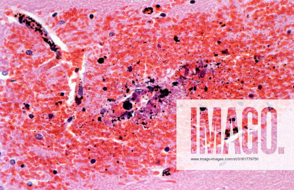 Plasmodium Falciparum Malaria Cerebral