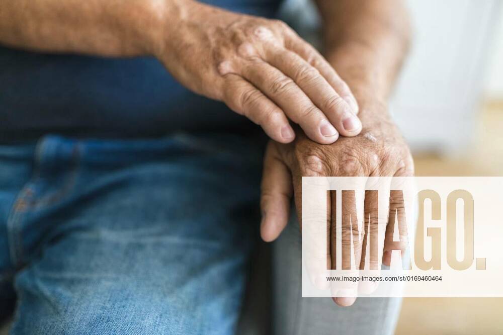 Elderly man suffering from psoriasis on hands, Elderly man suffering from psoriasis, closeup on hands, Elderly man suffering from psoriasis, closeup on hands model released, Symbolfoto , 01.06.2022,