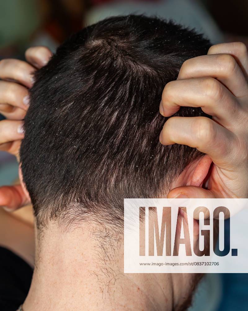Nahaufnahme von dunklem, von Schuppen befallenem Haar, die ein häufiges Kopfhautproblem verdeutlicht. Close-up shot of a person with dark hair and visible dandruff on their scalp, emphasizing the issue of scalp health and common skin condition. (License=RF) ,model released, Symbolfoto