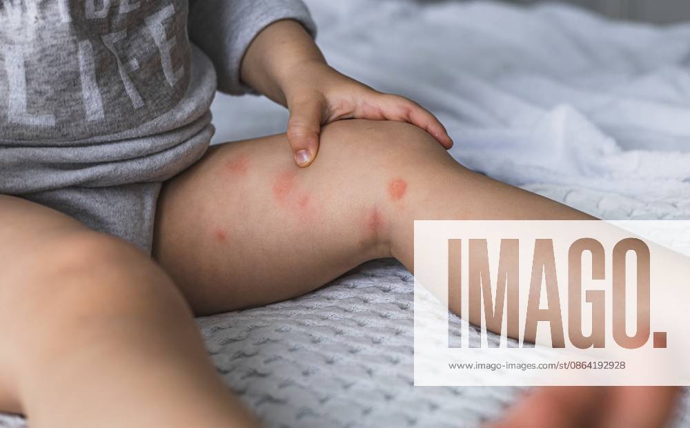 Babyfüße mit trockenen roten entzündeten Stellen bei Neurodermitis, Nahrungsmittelallergie oder Ekzemen. Konzept für Hauterkrankungen Baby feet with dry red inflamed spots of atopic dermatitis, food allergy or eczema disease. skin disease concept .
