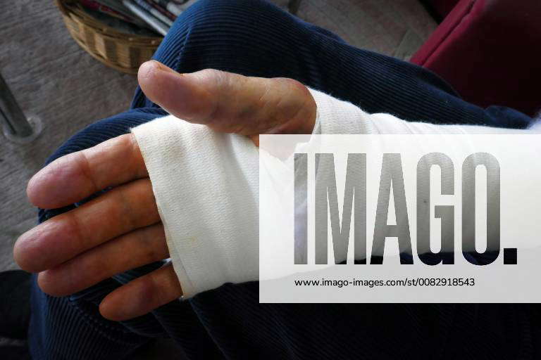 Medizin, Hand mit Verband nach Operation OP Karpaltunnelsyndrom (KTS ...