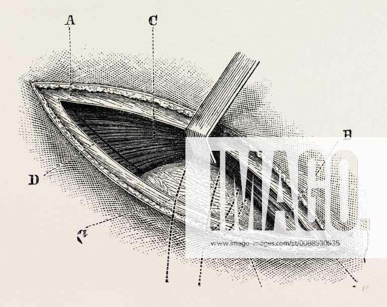 ligature of right external iliac artery, medical equipment, surgical