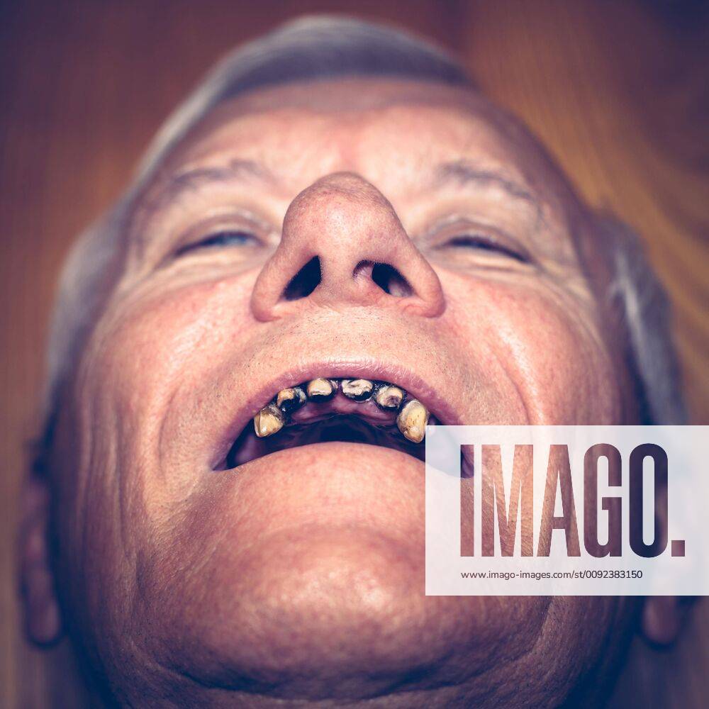 Old man with ugly teeth ,model released, Symbolfoto