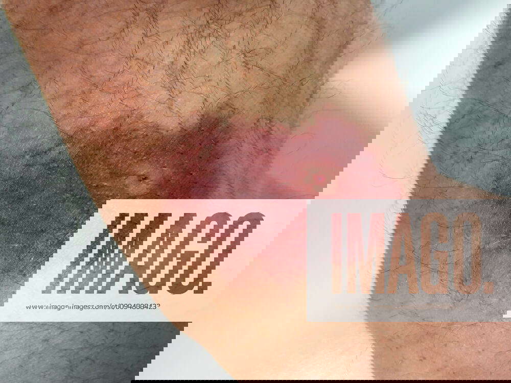 Bluterguss an einem Arm nach Legen eines Katheters und Einnahme eines Blutverduenners, Deutschland