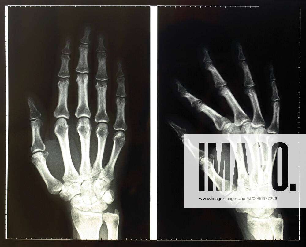 bones of the hand x ray