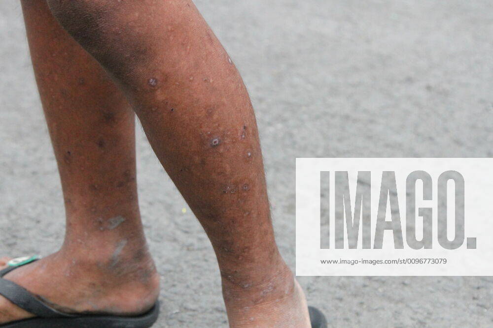 PhScabies and skin diseases caused by dirty water Dirty water and