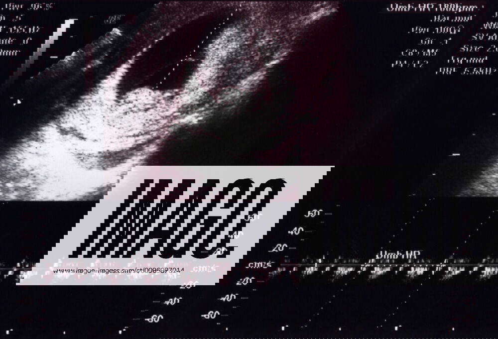 Ultrasound Scan 10 Weeks Heartbeat Ultrasound scan 10 weeks of new