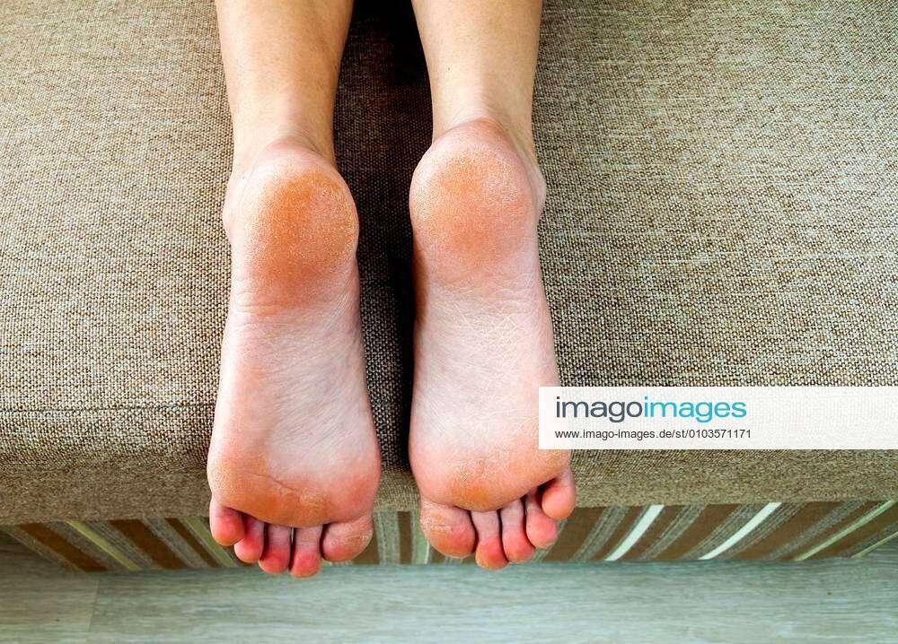 Dry cracked skin of woman feet in bed. Foot treatment. xFotosearchxLBRFx  xBilanolx