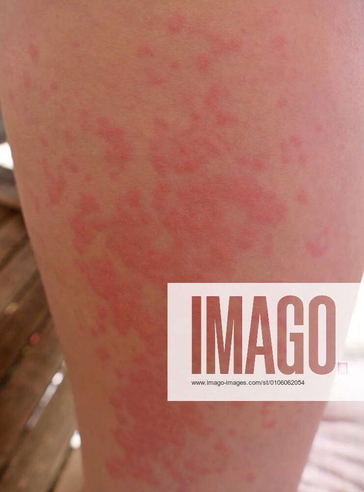 what is wandering rash