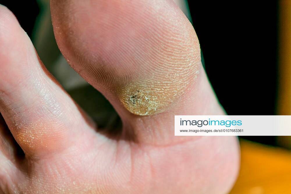 Plantar wart on big toe. Visible black dots warts. Shown the sole of