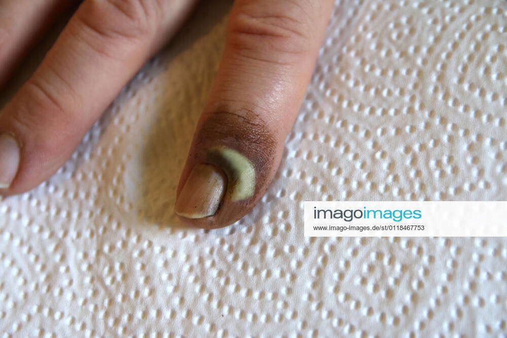 Nail bed inflammation after application of a traction ointment