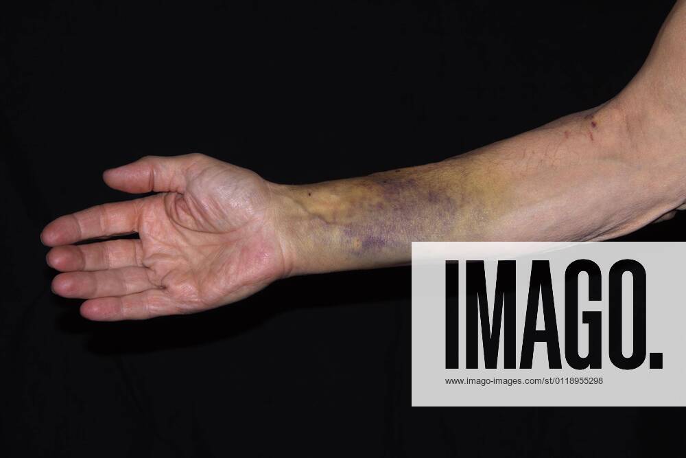 Patient with a bruise, hematoma, on the right arm, after insertion of a pacemaker, Germany, Europe