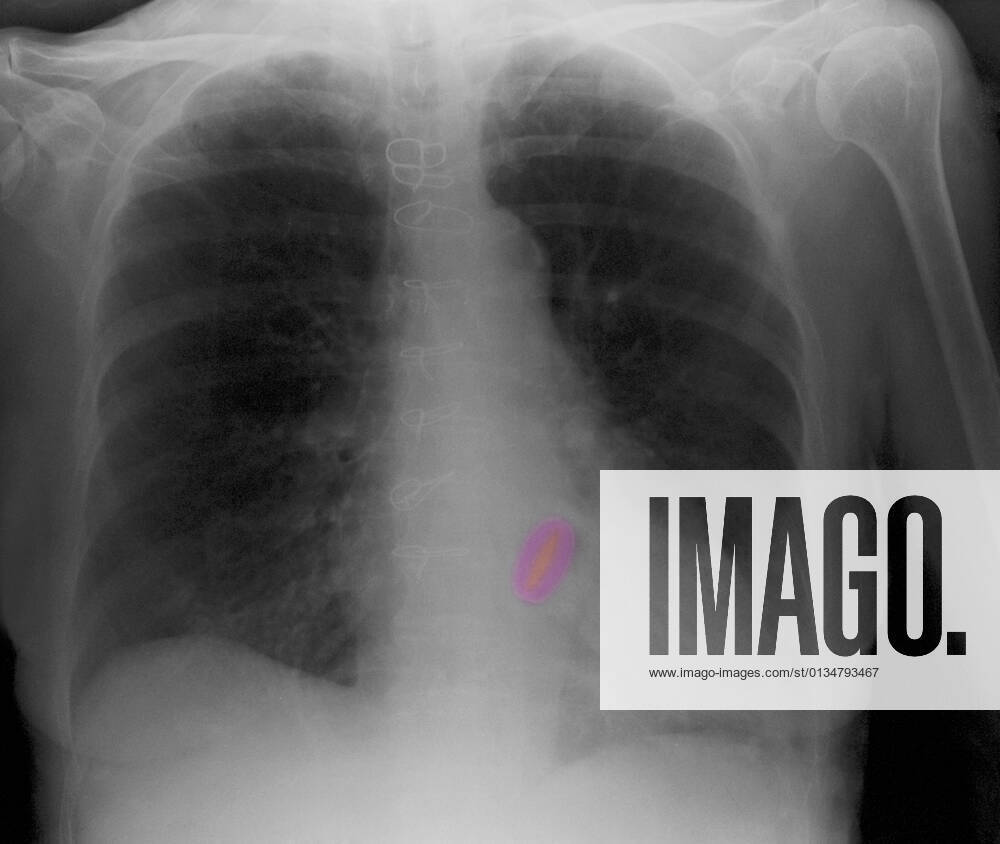 CXR of elderly woman, heart valve replacement