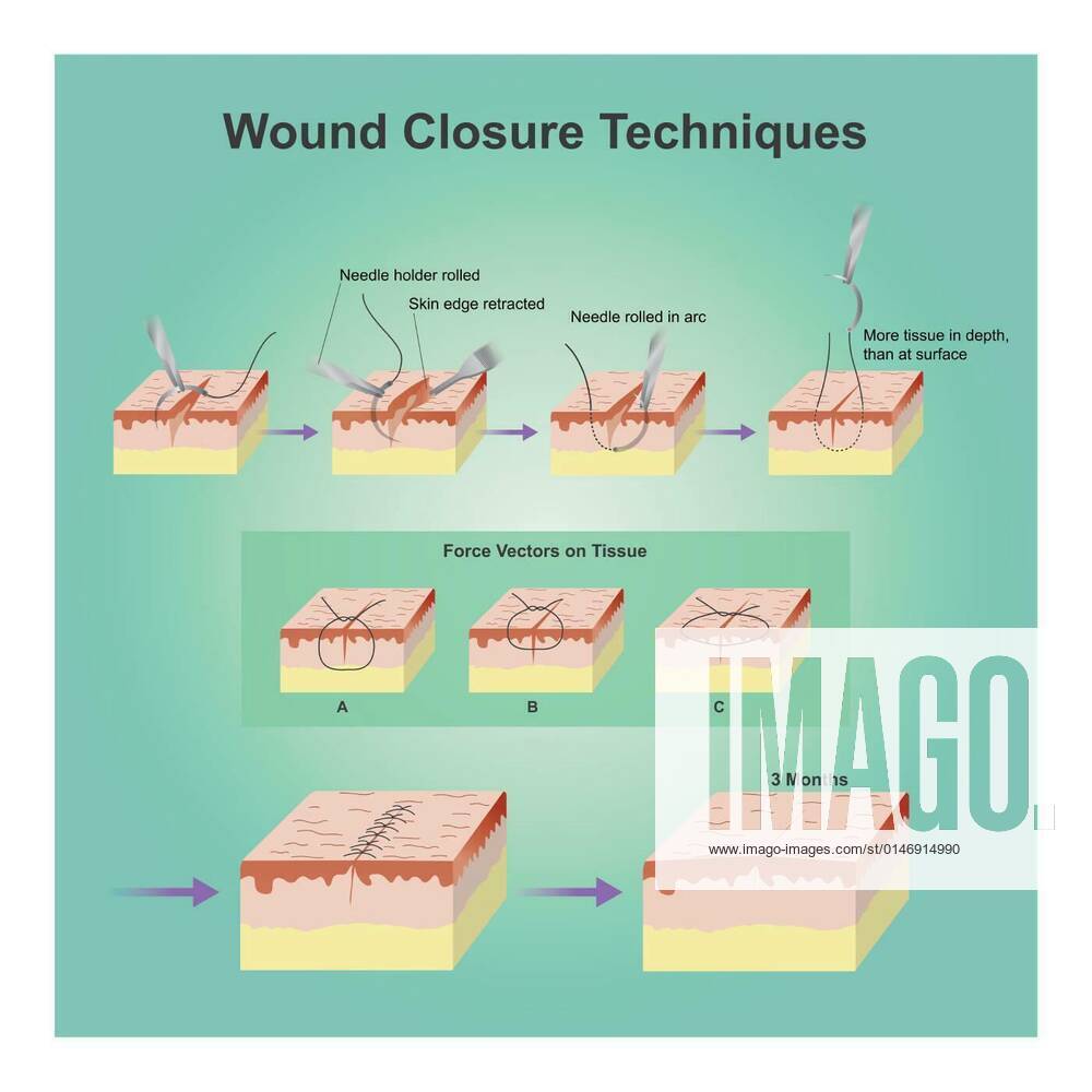 Wound Closure Techniques