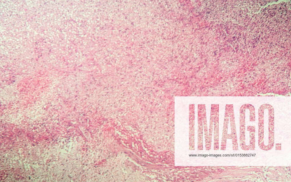 Gallbladder necrosis tissue under the microscope 100x, model released ...