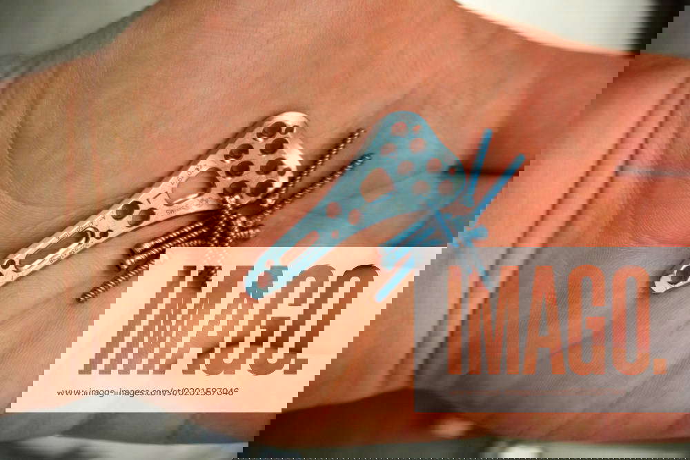 An explanted surgical blue titanium radius plate lies on the