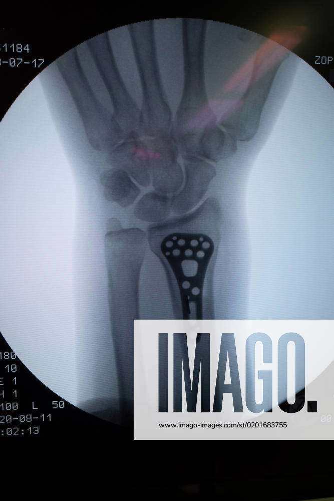 An Xray shows a wrist with a titanium