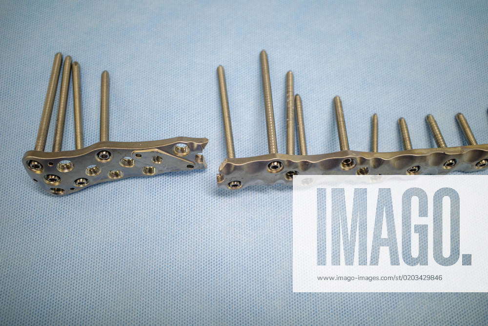 a broken titanium plate was explanted from a