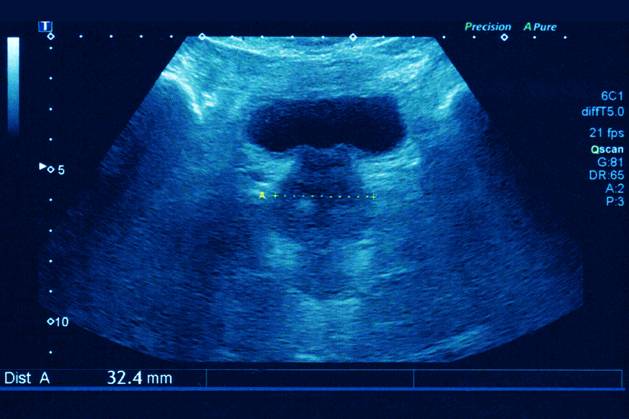 Prostate Ultrasound Prostate Ultrasound To Visualize The Volume And