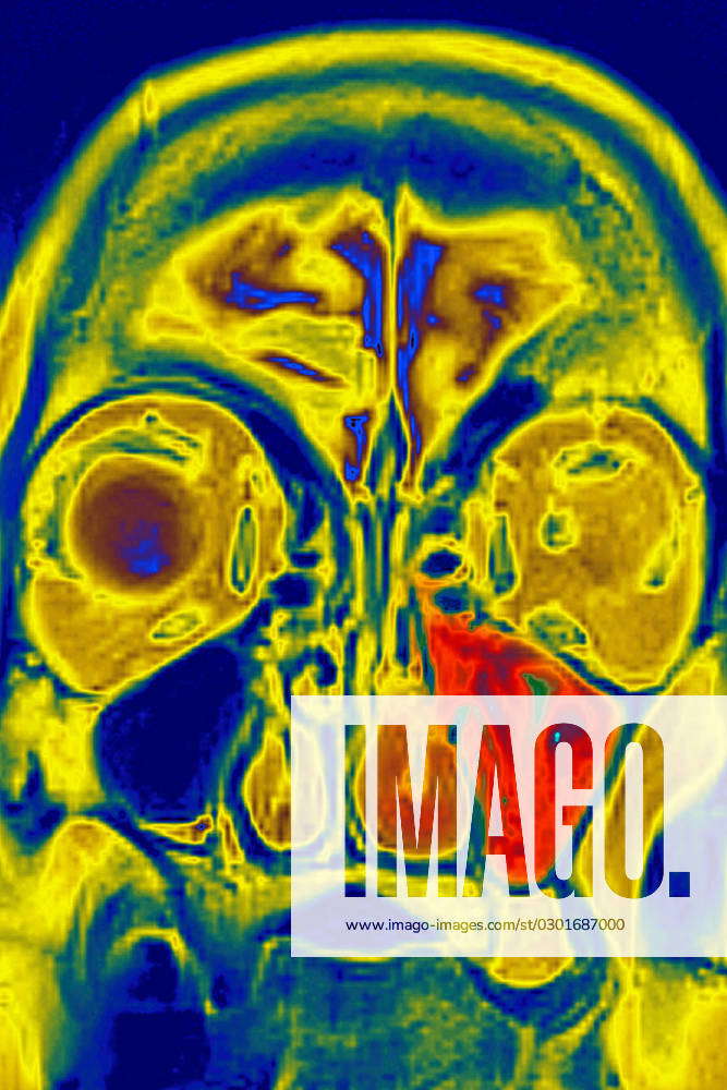 Sinusitis Mri Sinusitis In The Left Maxillary Sinus Seen On A Frontal