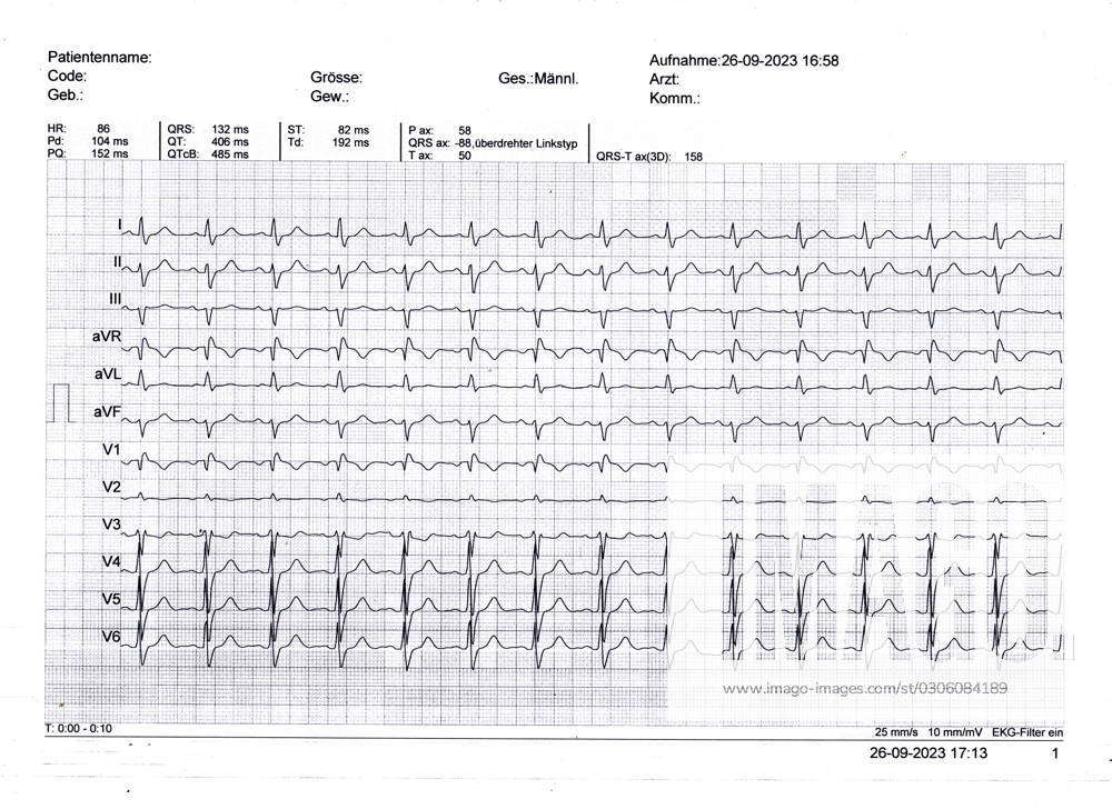 Image of an ECG An electrocardiogram ECG from a 61 year old man to ...